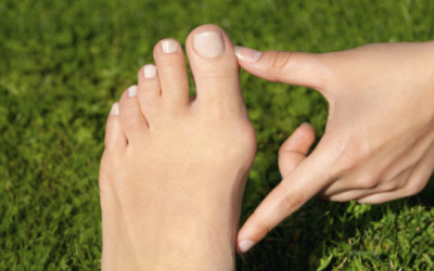 Oignons aux Pieds : Comprendre, Prévenir et Traiter Cette Douleur Courante!