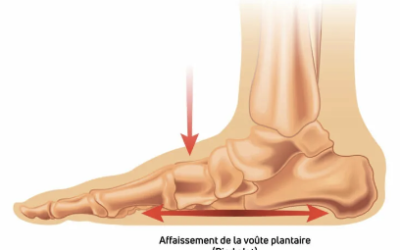 Tout Savoir sur le Pied Plat : Causes, Conséquences et Solutions efficaces